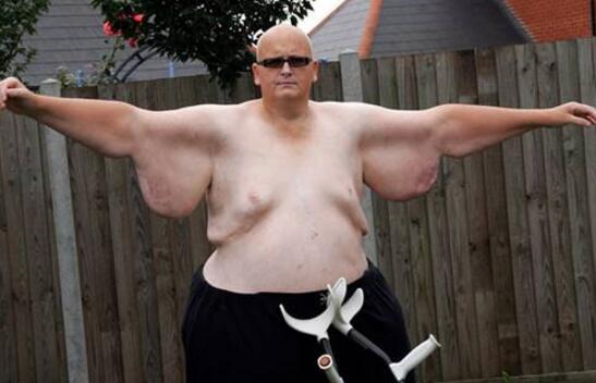 盘点世界最胖男人,最重美国男子体重572公斤